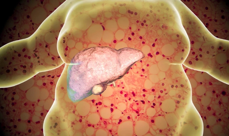 Yağlı karaciğer hastalığının tedavisi bulundu! Etkisini 3 ayda gösteriyor
